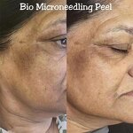 Bio Spicule Sponge Manufacturer - G Microneedle Peel Acne Treatment Non-invasive Algae
