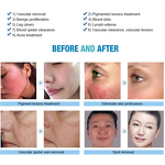 Diode Laser for Vascular Removal Factory - 980nm Spider Vein Removal Blood Laser