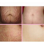 Skin Resurfacing Machine Manufacturer - OEM/ODM GZ Factory Direct Selling CO2 for Acne