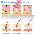 Diode Laser Hair Removal Machine Factory - Blue White 2 in 1 755 808 1064nm