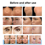 Professional Handheld RF Machine Factory - Face Body Treatment Mesotherapy Wrinkle Removal