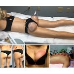 Butt Lifting Machine Factory - Y Pressotherapy Vacuum Suction Chest Buttock Lift
