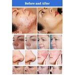 1927nm Beauty Equipment Factory - T Factory Price Fractional with 2 Probes Acne Rejuvenation