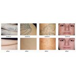 Non-invasive Eyebrow Washing Machine Factory - ZS Newest High Power Tattoo Removal