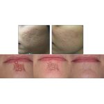 Skin Resurfacing Machine Manufacturer - OEM/ODM GZ Factory Direct Selling CO2 for Acne