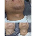 Hair Removal Equipment Factory - Fast Effective Obviously Result Beard Remove