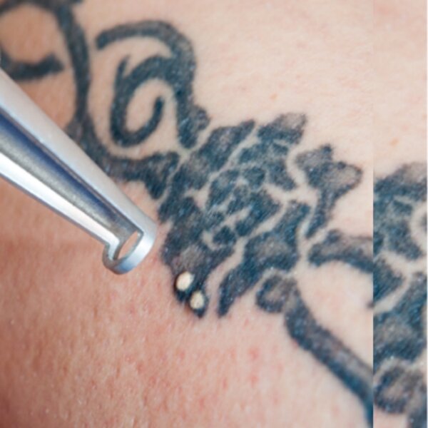 Permanent Freckles Remover Manufacturer - Black Pigment Removal Carbon Peeling Skin