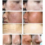 Smart Skin Management Machine Manufacturer - ZS Factory EVA Micro Bubble Oxygen Jet Microdermabrasion