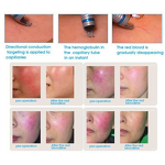 Diode Laser for Vascular Removal Factory - 980nm Spider Vein Removal Blood Laser