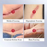 Pregnancy Scar Cream Factory - Women's Lighten Body Skin