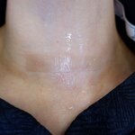 Scar Removal Sheets Manufacturer - Silicone Strips Fade