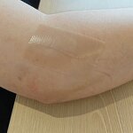 Scar Silicone Strips Manufacturer - Clear Medical Grade Tape