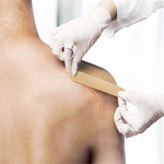 Keloid Sheet Manufacturer - Transparent Silicone Removal