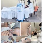 Diode Laser Machine Supplier - 1064nm Skin Tightening Stretch