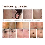 Pico Laser Machine Manufacturer - Long Pulse 450Ps Tattoo Removal