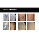 Picosecond Laser Factory - Bulk High Quality Picosecond Laser Tattoo Removal Air Water Cooling