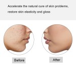 Acne Laser Pen Factory - Bulk Acne Laser Pen Portable Wrinkle Removal Machine Durable Soft