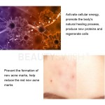 Acne Laser Pen Factory - Bulk Acne Laser Pen Portable Wrinkle Removal Machine Durable Soft