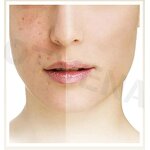 Face Serum Manufacturer - OEM Anti Melasma Acne Removal Lyophilized Powder