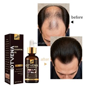 Hair Growth Oil Manufacturer - Organic Fast Hair Loss Treatment