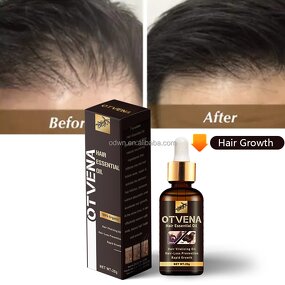 Hair Growth Oil Manufacturer - OEM Organic Fast Hair Loss Treatment