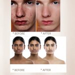 Skin Care Set Supplier - OEM Organic Strong Effect Anti Acne