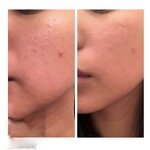 Hydrocolloid Pimple Patches Factory - OEM Transparent Day Night Hydrocolloid