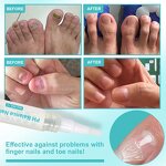 Nail Repair Pen Manufacturer - OEM Damaged Nail Onychomycosis Fungus Pen