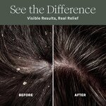 Hair Oil Spray Manufacturer - OEM Hand free Herbal Scalp Care Anti Dandruff