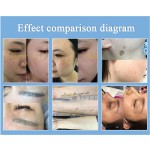 Laser Machine Manufacturer - Picosecond Q Switch Tattoo Removal