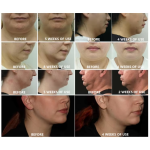 Cryolipolysis Machine Supplier - 2025 Portable Fat Freezing Slimming