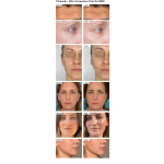 EMRF Machine Factory - Professional PE Face Muscle Training