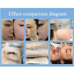 Pico Laser Machine Factory - Portable 1064/532/1320nm Carbon Peel