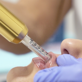 自动注射器源头工厂-面部唇部填充透明质酸笔