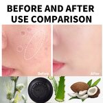 Salicylic Acid Soap Bar - 100g Deep Cleansing Anti-Acne Whitening