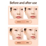 激光等离子笔生产厂家-皮肤标签雀斑乳头瘤去除