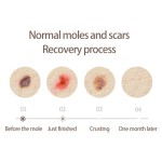 激光等离子笔生产厂家-皮肤标签雀斑乳头瘤去除