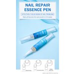 Nail Repair Pen Manufacturer - 4ml Anti Fungal Treatment for Onychomycosis Paronychia Finger Toenail Fungus
