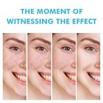 Anti-Acne Face Gel Manufacturer - Private Label Quick Salicylic Acid Herbal for Pimples and Scars