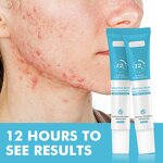 Anti-Acne Face Gel Manufacturer - Private Label Quick Salicylic Acid Herbal for Pimples and Scars