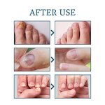 Nail Repair Serum Gel Manufacturer - Maximum Strength Anti-Infection for Onychomycosis Paronychia Fungal Treatment