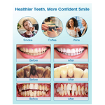 Ultrasonic Tooth Cleaner - Electric Tartar Stains Removal Oral Cleaning Machine