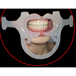 Dental Cheek Retractor - High Quality Disposable C-Shape Mouth Opener Teeth Whitening Accessory