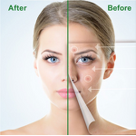 Acne Patch - 2022 Hot Sale Customized Shapes Healing Pimple Master Spot Dressing