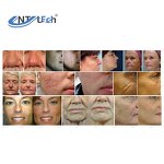 Co2 Fractional Laser - 40W Scar Removal Vaginal Tightening Beauty Machine