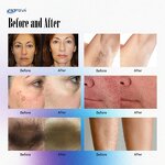 Alexandrite Laser Machine - 755nm Nd Yag Hair Removal Skin Rejuvenation Device