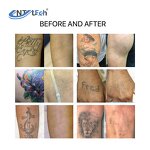 Q Switched Nd Yag Laser - Best Selling Tattoo Removal with Air Cooler Head