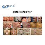 4d Co2 Fractional Laser - Multi-Function Vaginal Resurfacing Wrinkles Portable