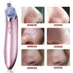 Vacuum Blackhead Remover - Rechargeable 4 Interchangeable Suck Heads Pore Cleaner