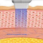 Skin Care Machine Manufacturer - 7D for Skin Tightening & Face Lifting